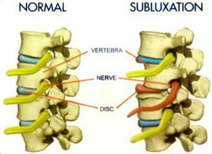 subluxation