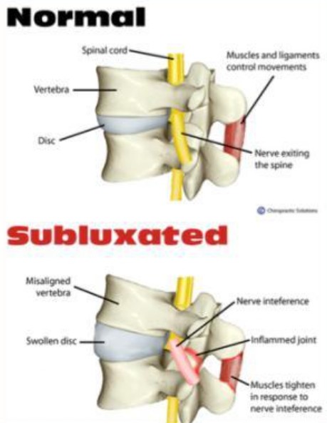 Vertebral Subluxation Complex
