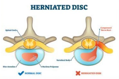 HERNIATED DISC