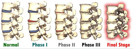 Disc Degeneration