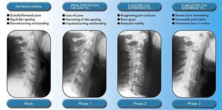 Disc Degeneration 2